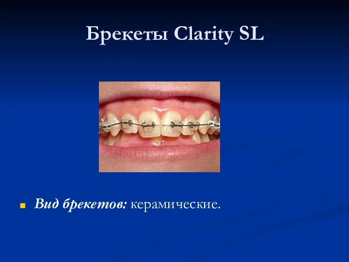 Брекеты Clarity SL Вид брекетов: керамические.