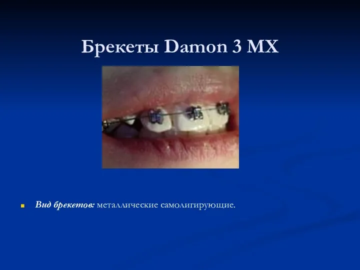 Брекеты Damon 3 MX Вид брекетов: металлические самолигирующие.