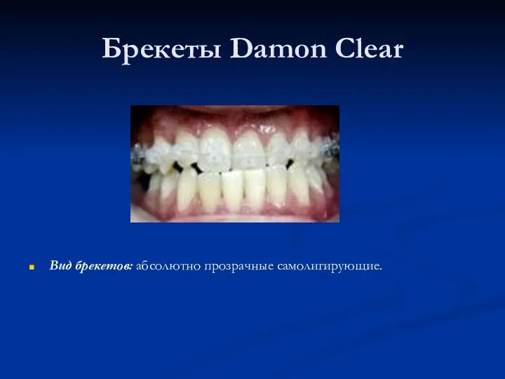 Брекеты Damon Clear Вид брекетов: абсолютно прозрачные самолигирующие.