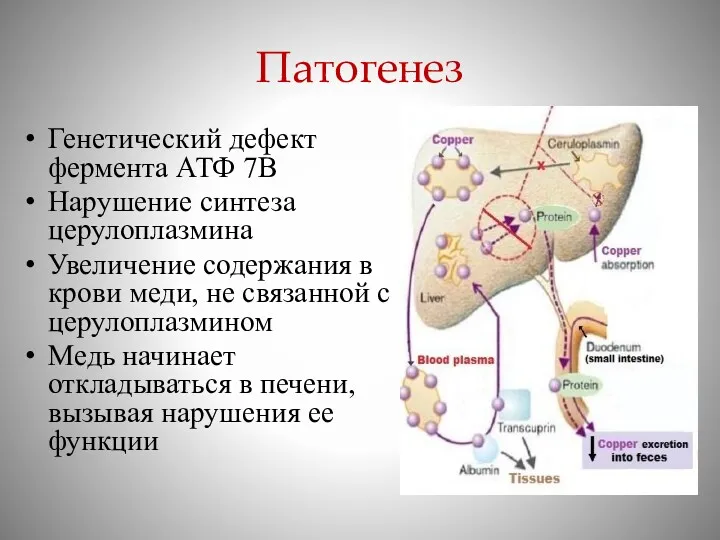 Патогенез Генетический дефект фермента АТФ 7В Нарушение синтеза церулоплазмина Увеличение