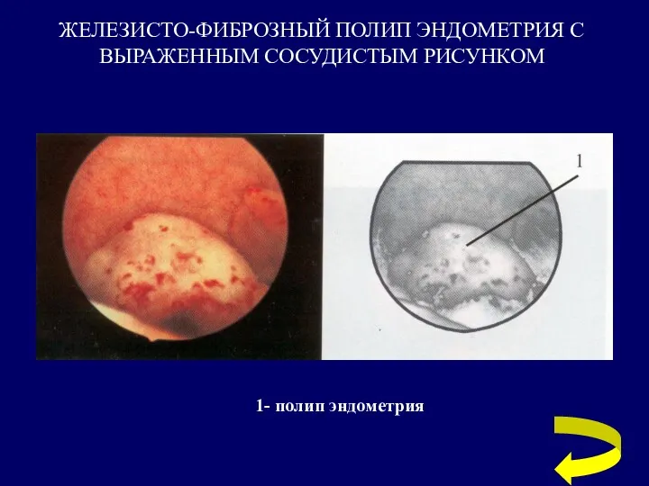 ЖЕЛЕЗИСТО-ФИБРОЗНЫЙ ПОЛИП ЭНДОМЕТРИЯ С ВЫРАЖЕННЫМ СОСУДИСТЫМ РИСУНКОМ 1- полип эндометрия