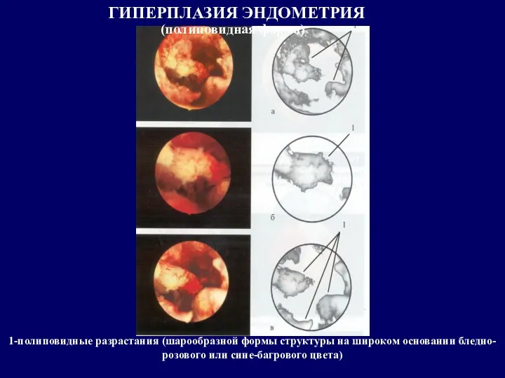 ГИПЕРПЛАЗИЯ ЭНДОМЕТРИЯ (полиповидная форма) 1-полиповидные разрастания (шарообразной формы структуры на широком основании бледно-розового или сине-багрового цвета)