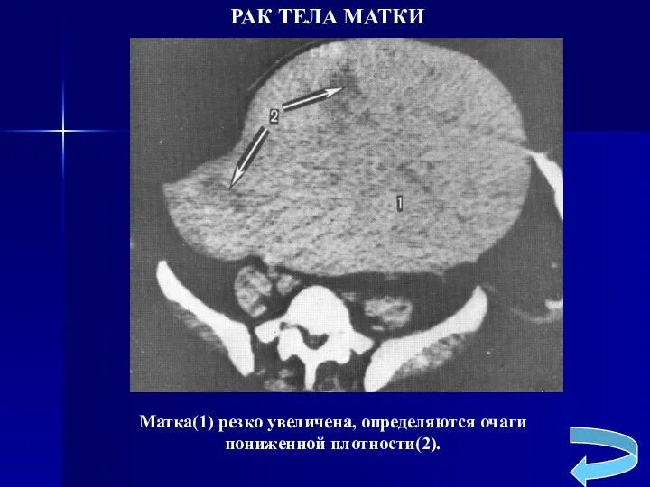 РАК ТЕЛА МАТКИ Матка(1) резко увеличена, определяются очаги пониженной плотности(2).
