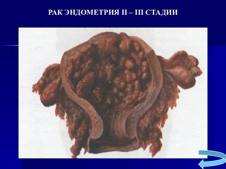 РАК ЭНДОМЕТРИЯ II – III СТАДИИ