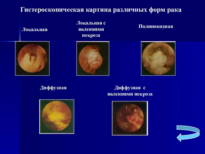 Локальная Локальная с явлениями некроза Полиповидная Диффузная Диффузная с явлениями некроза Гистероскопическая картина различных форм рака