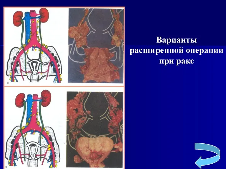 Варианты расширенной операции при раке