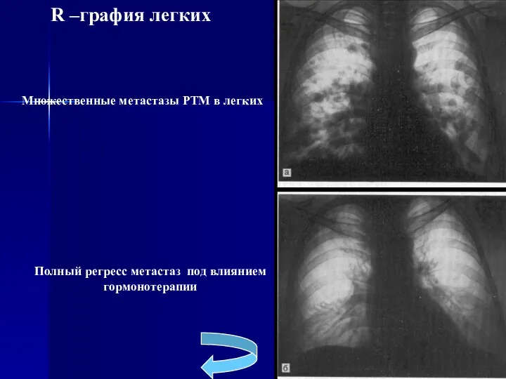Множественные метастазы РТМ в легких Полный регресс метастаз под влиянием гормонотерапии R –графия легких