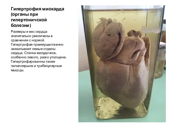 Гипертрофия миокарда (органы при гипертоничской болезни) Размеры и вес сердца
