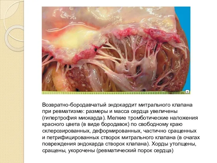 Возвратно-бородавчатый эндокардит митрального клапана при ревматизме: размеры и масса сердца увеличены (гипертрофия миокарда).