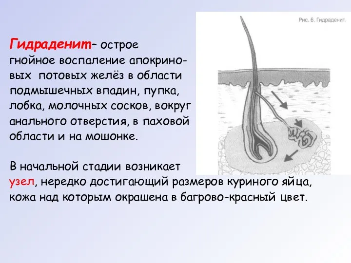 Гидраденит – острое гнойное воспаление апокрино- вых потовых желёз в области подмышечных впадин,