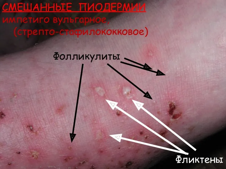 СМЕШАННЫЕ ПИОДЕРМИИ импетиго вульгарное, (стрепто-стафилококковое) Фликтены Фолликулиты