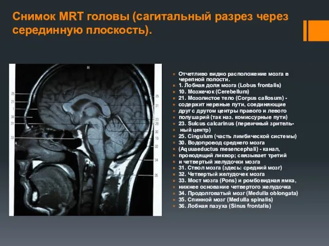 Снимок MRT головы (сагитальный разрез через серединную плоскость). Отчетливо видно