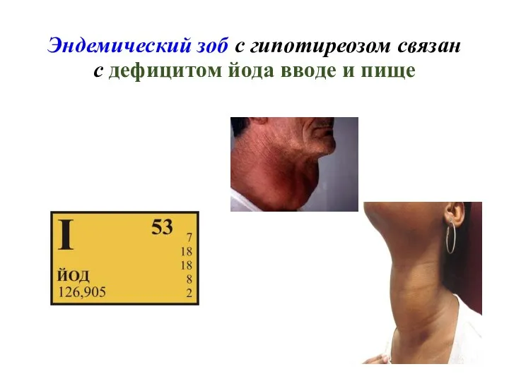 Эндемический зоб с гипотиреозом связан с дефицитом йода вводе и пище