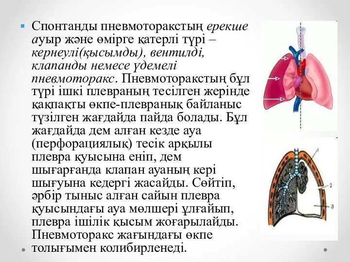 Спонтанды пневмоторакстың ерекше ауыр және өмірге қатерлі түрі – кернеулі(қысымды),