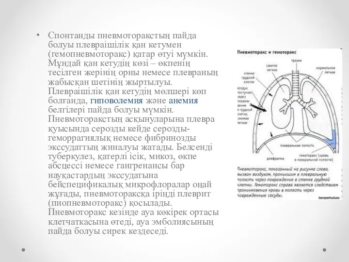 Спонтанды пневмоторакстың пайда болуы плевраішілік қан кетумен (гемопневмоторакс) қатар өтуі