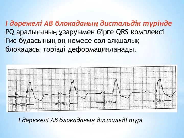 I дәрежелі АВ блокаданың дистальдік түрінде РQ аралығының ұзаруымен бірге