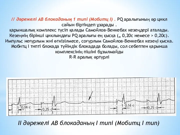 // дәрежелі АВ блокаданың 1 типі (Мобитц I) . PQ