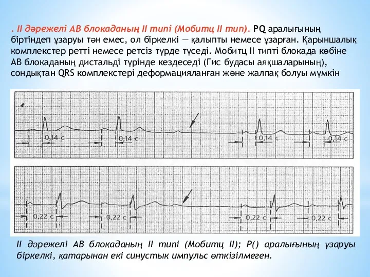 . II дәрежелі АВ блокаданың II типі (Мобитц II тип).