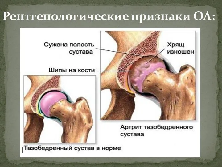 Рентгенологические признаки ОА: