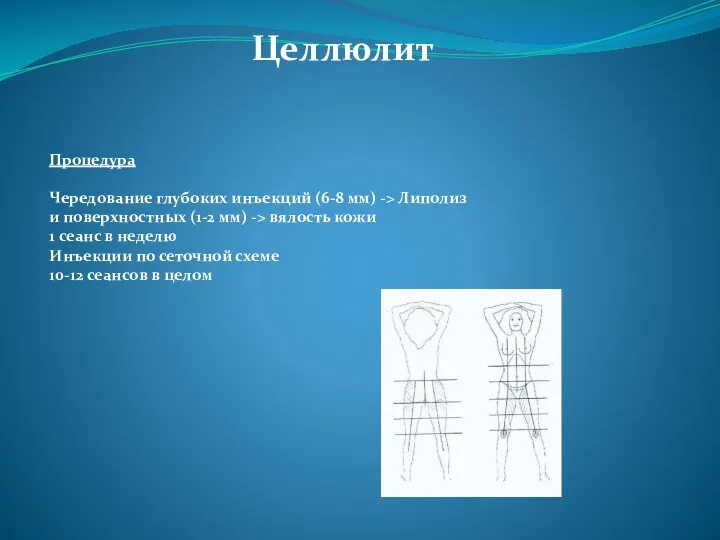 Целлюлит Процедура Чередование глубоких инъекций (6-8 мм) -> Липолиз и поверхностных (1-2 мм)