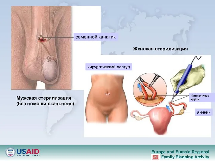 Мужская стерилизация (без помощи скальпеля) Женская стерилизация