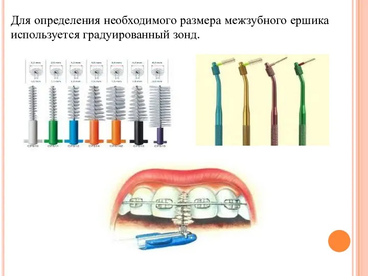 Для определения необходимого размера межзубного ершика используется градуированный зонд.