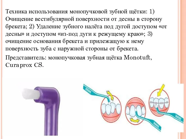 Техника использования монопучковой зубной щётки: 1) Очищение вестибулярной поверхности от