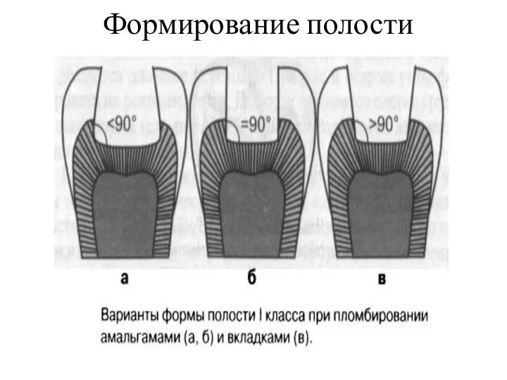 Формирование полости