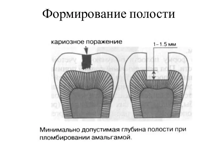 Формирование полости