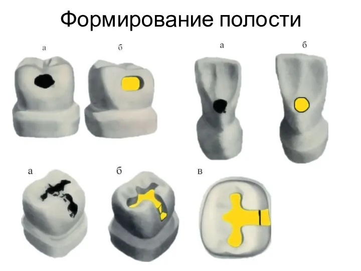 Формирование полости