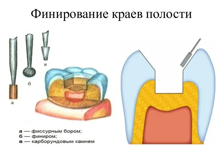 Финирование краев полости