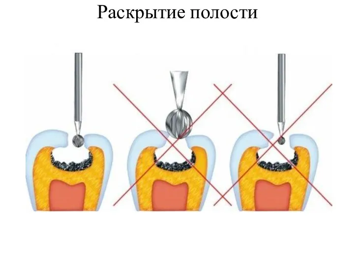 Раскрытие полости