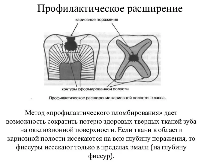 Профилактическое расширение Метод «профилактического пломбирования» дает возможность сократить потерю здоровых