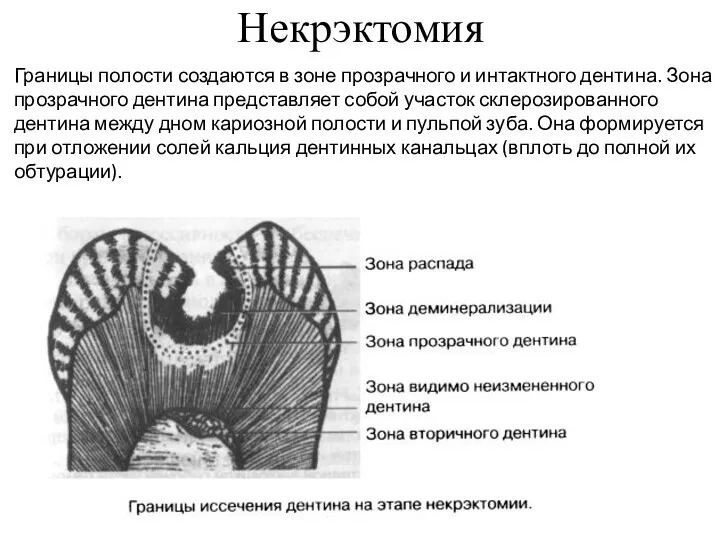 Некрэктомия Границы полости создаются в зоне прозрачного и интактного дентина.