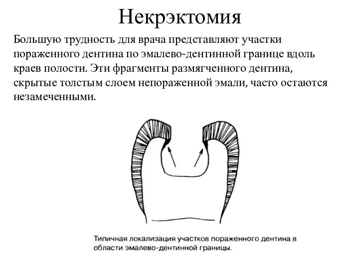 Некрэктомия Большую трудность для врача представляют участки пораженного дентина по