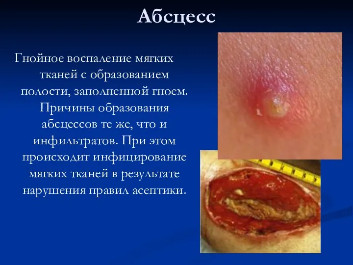 Абсцесс Гнойное воспаление мягких тканей с образованием полости, заполненной гноем.