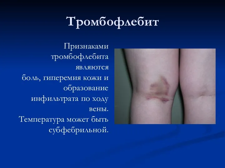 Тромбофлебит Признаками тромбофлебита являются боль, гиперемия кожи и образование инфильтрата