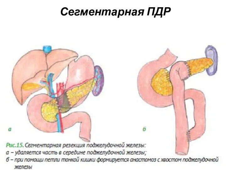 Сегментарная ПДР