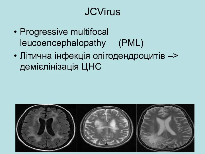 JCVirus Progressive multifocal leucoencephalopathy (PML) Літична інфекція олігодендроцитів –> демієлінізація ЦНС