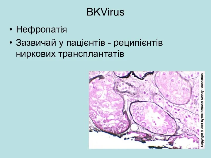 BKVirus Нефропатія Зазвичай у пацієнтів - реципієнтів ниркових трансплантатів