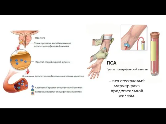 – это опухолевый маркер рака предстательной железы.