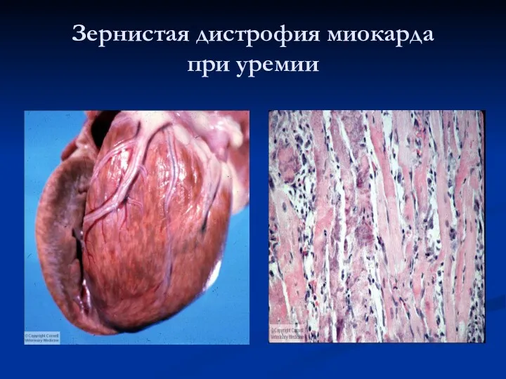 Зернистая дистрофия миокарда при уремии