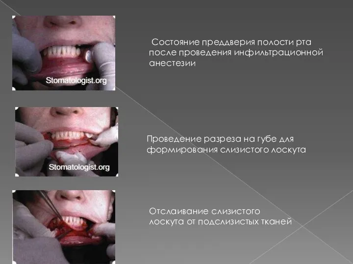 Состояние преддверия полости рта после проведения инфильтрационной анестезии Проведение разреза