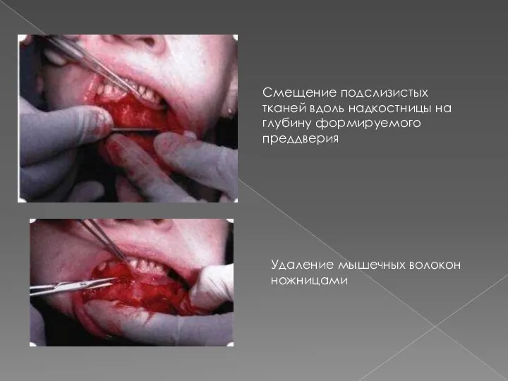 Смещение подслизистых тканей вдоль надкостницы на глубину формируемого преддверия Удаление мышечных волокон ножницами