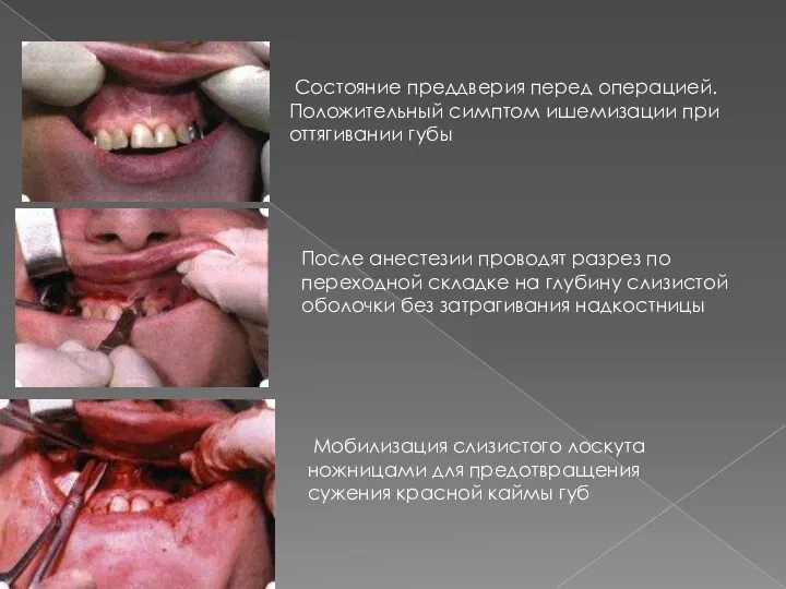 Состояние преддверия перед операцией. Положительный симптом ишемизации при оттягивании губы