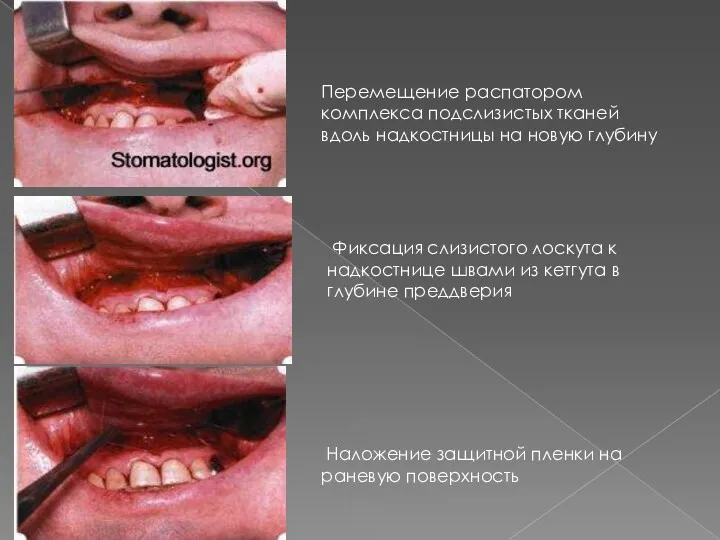 Перемещение распатором комплекса подслизистых тканей вдоль надкостницы на новую глубину