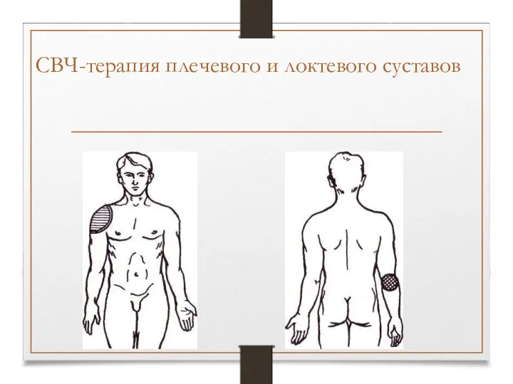 СВЧ-терапия плечевого и локтевого суставов