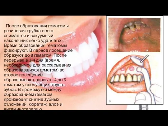 После образования гематомы резиновая трубка легко снимается и вакуумный наконечник