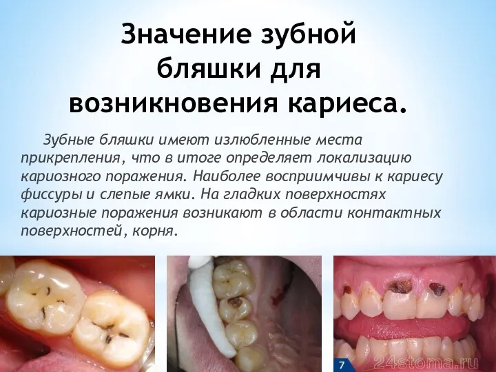 Значение зубной бляшки для возникновения кариеса. Зубные бляшки имеют излюбленные
