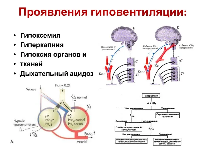 Проявления гиповентиляции: Гипоксемия Гиперкапния Гипоксия органов и тканей Дыхательный ацидоз